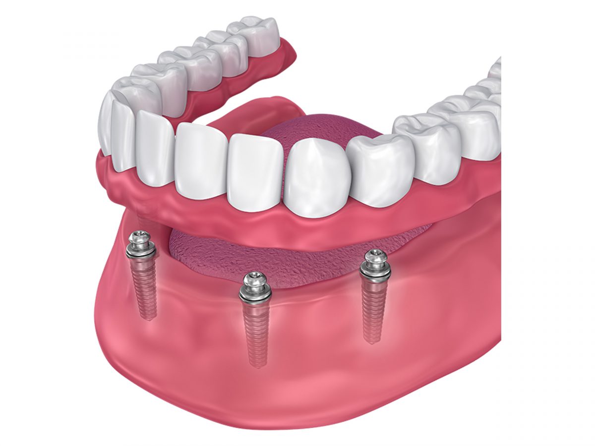 Implant Dentures In New Port Richey | Implant Dentures Near You