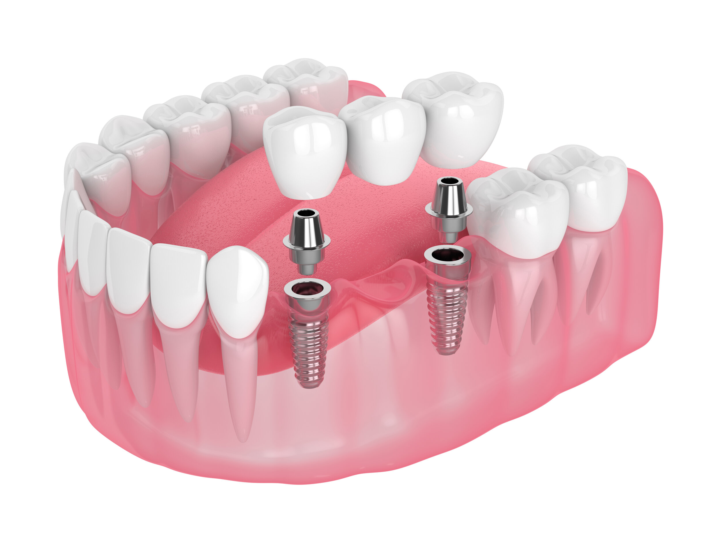 Dental Implant Bridges In New Port Richey Dental Implant Bridges Near You