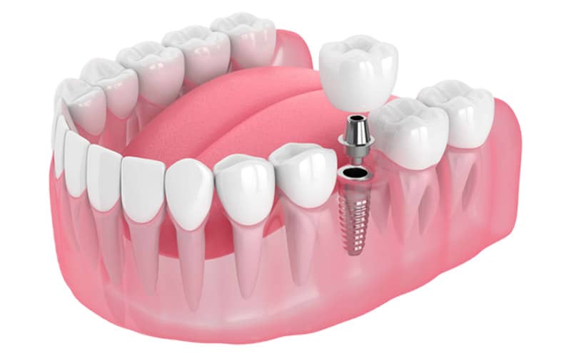 Single Tooth Dental Implants in New Port Richey